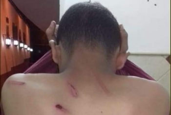  معلم يصيب طالبًا بكدمات في أبوحماد