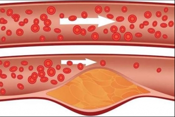  طرق بسيطة لتنظيف الأوعية الدموية من ترسبات الكوليسترول