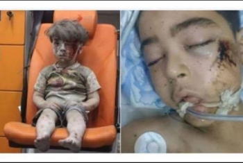  وفاة شقيق الطفل السوري عمران دقنيش