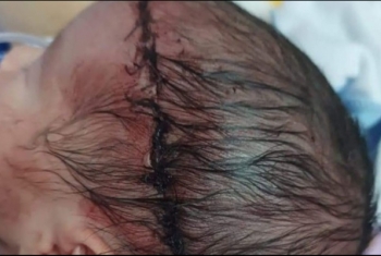  إصابة طفل حديث الولادة بقطع في الرأس أثناء الولادة بالعاشر